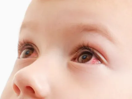 Triệu chứng đau mắt đỏ: dấu hiệu, nguyên nhân, chẩn đoán và điều trị 13