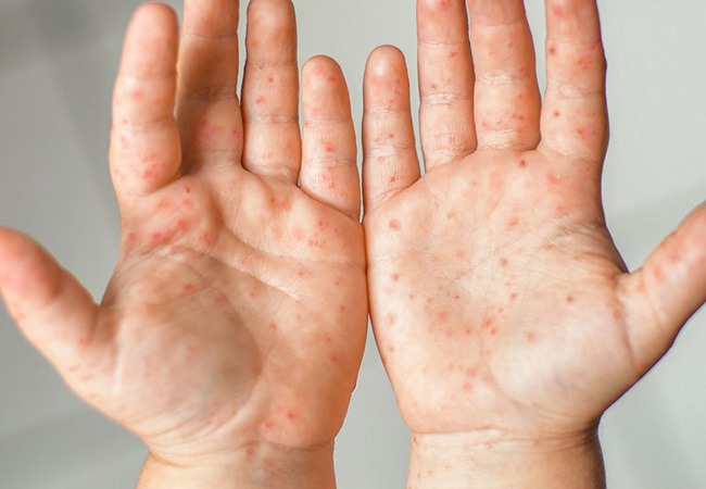 Lòng bàn tay nổi đốm đỏ - Nguyên nhân và giải pháp điều trị 1