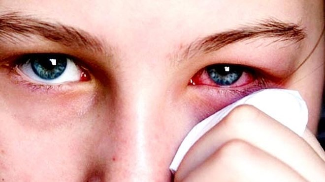 Đau mắt đỏ bị sưng - Nguyên nhân và cách điều trị hiệu quả 9