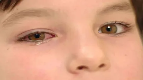Triệu chứng đau mắt đỏ: dấu hiệu, nguyên nhân, chẩn đoán và điều trị 1