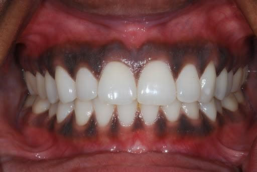 Nướu răng bị đen: Tìm hiểu nguyên nhân và cách khắc phục 5