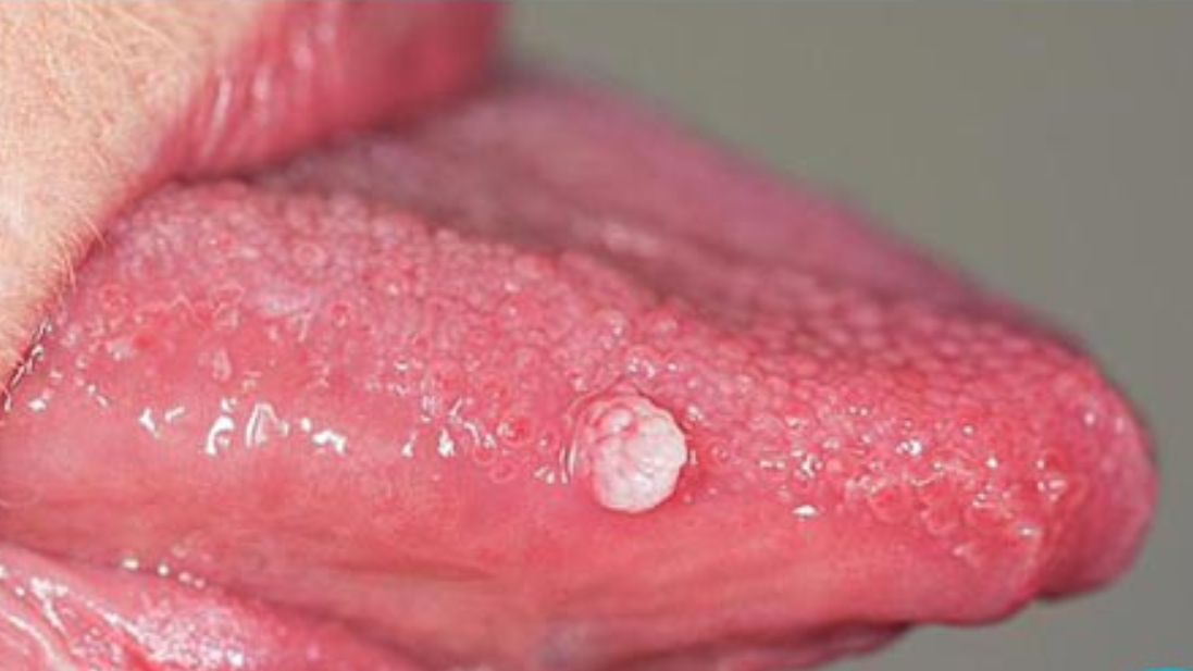 Sùi mào gà ở lưỡi: Nguyên nhân, dấu hiệu và cách điều trị 7