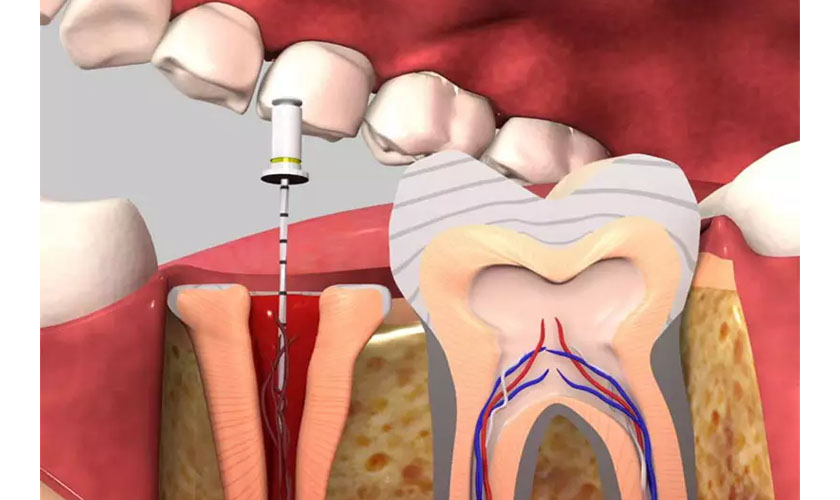 Cách giảm đau răng sau khi lấy tủy 7