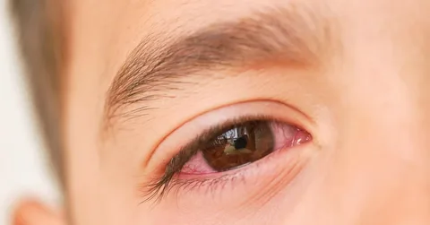 Thuốc nhỏ mắt trị đau mắt đỏ cho trẻ em 1
