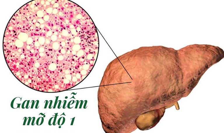 GAN NHIỄM MỠ ĐỘ 1: NGUYÊN NHÂN, DẤU HIỆU VÀ CÁCH ĐIỀU TRỊ 3