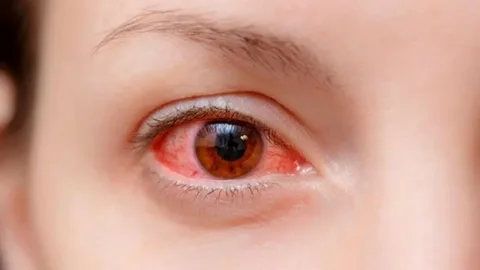 Thuốc nhỏ mắt tobrex và những điều bạn cần biết 15