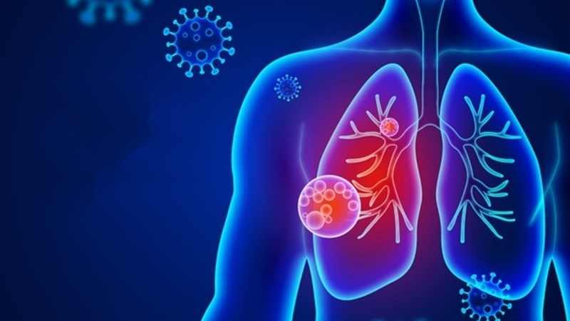 Bệnh viêm phổi virus corona nguy hiểm như thế nào? 5